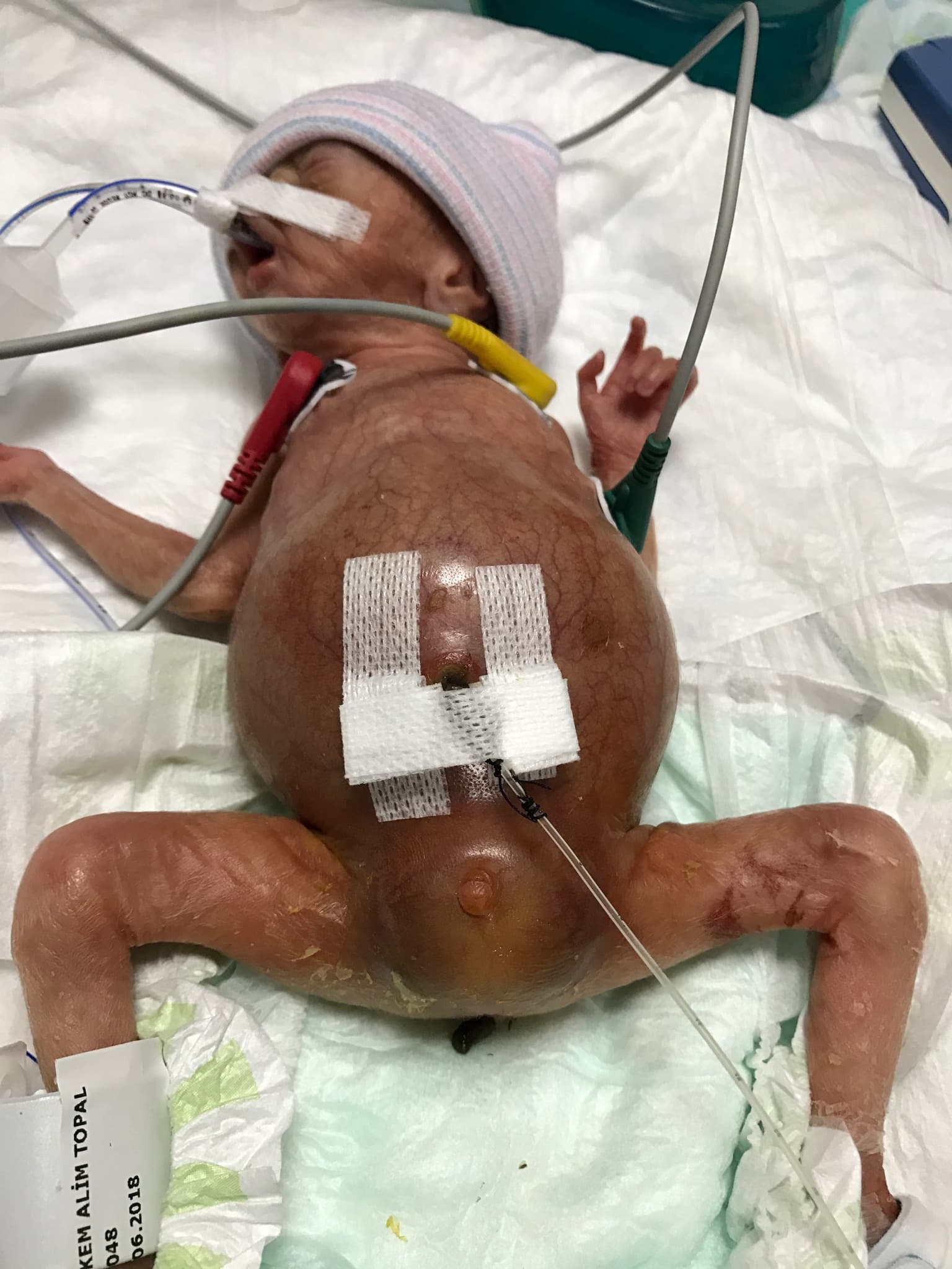 Prenatal Hydronephrosis — bilgilendirme görseli